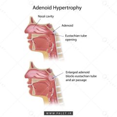 آناتومی هیپرتروفی آدئونید