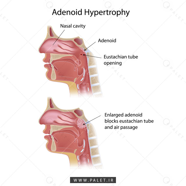 آناتومی هیپرتروفی آدئونید