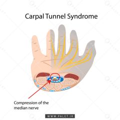 آناتومی سندرم تونل کارپال